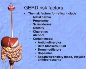 Acid Reflux and GERD